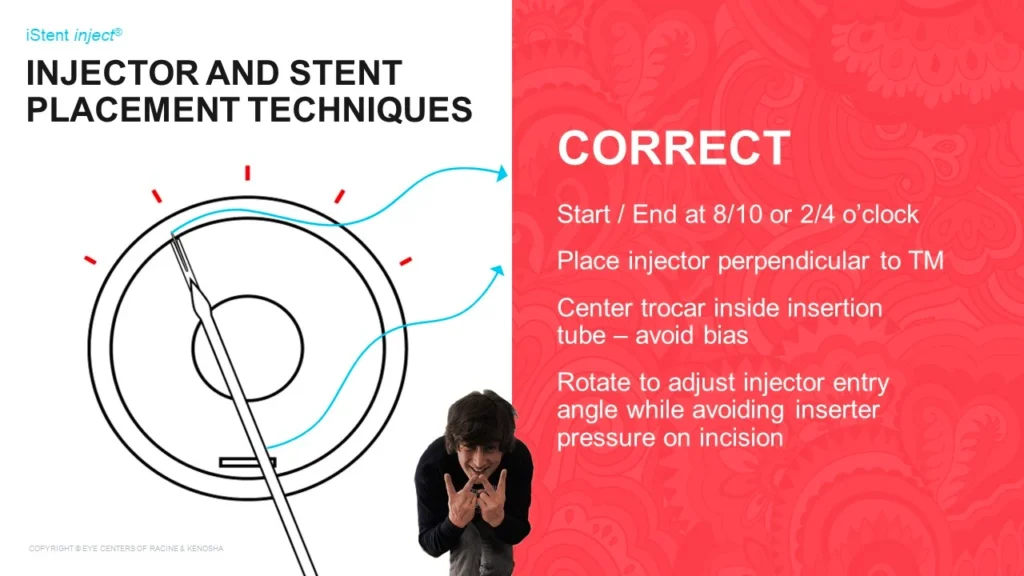 Injector and Stent Placement Techniques - Eye Centers Healthcare Presentation Diagram Slide 9